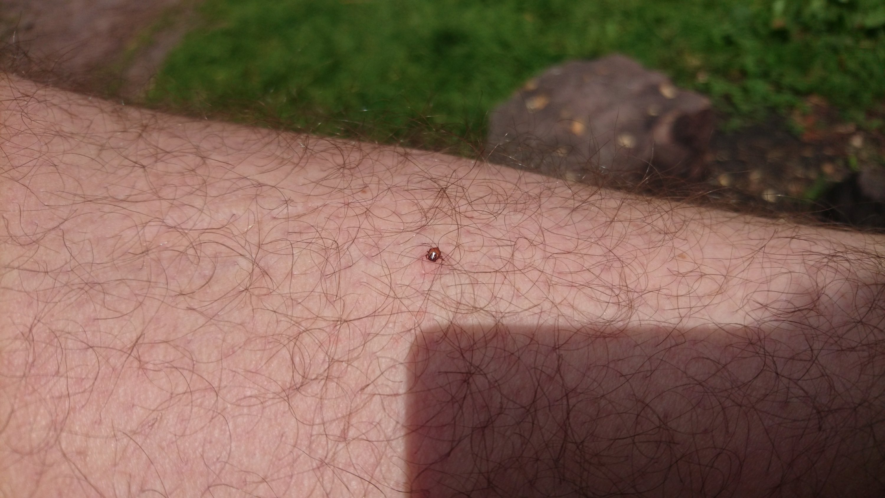 tick embedded in my leg.